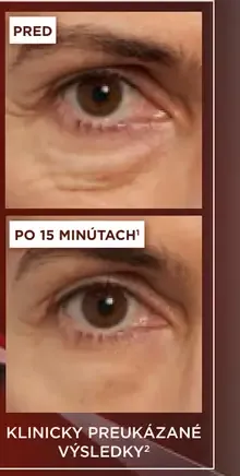 L'Oréal Paris Revitalift Laser Eye Bag Remover